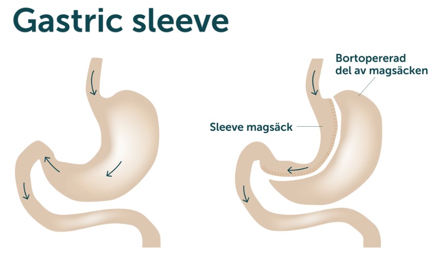 överviktsoperation, gastric sleeve