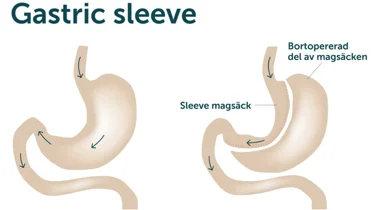 överviktsoperation, gastric sleeve